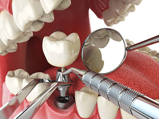 Best Chipped Tooth Repair Near Me  in Dolgeville, NY
